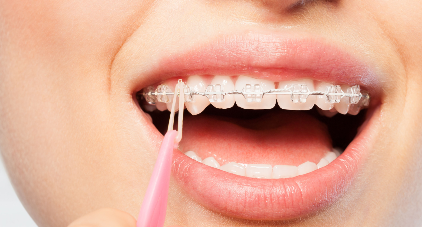 Les élastiques en orthodontie, Dr Janssens