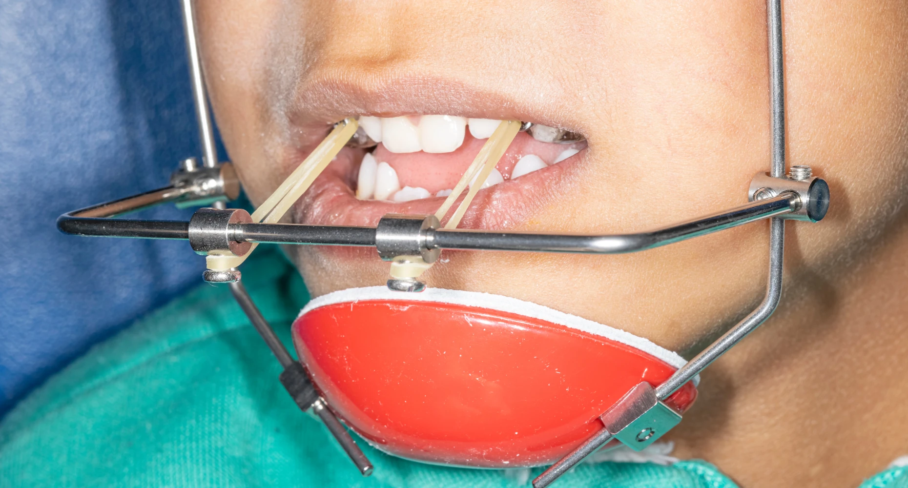 Masque facial, Orthodontiste enfant Paris 16